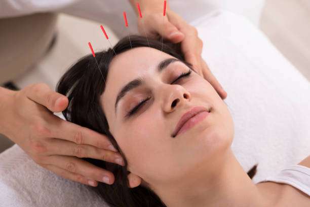 Relaxed Young Woman Receiving Acupuncture Treatment In Beauty Spa